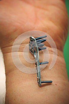 explanted surgical blue titanium radius plate lies on the wrist