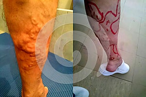 Extended Vein -Leg Disease - Preparing for Operation