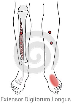 Extensor digitorum longus myofascial trigger points cause pain on the top of the foot