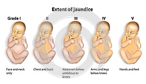 Extent of Jaundice icterus with Baby