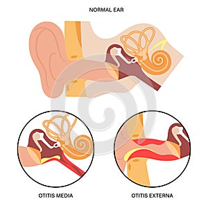 Externa media otitis