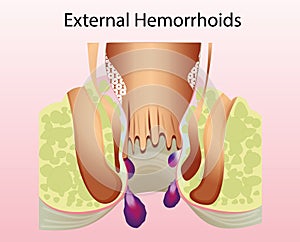 External hemorrhoid. Unhealthy lower rectum with inflamed vascular structures