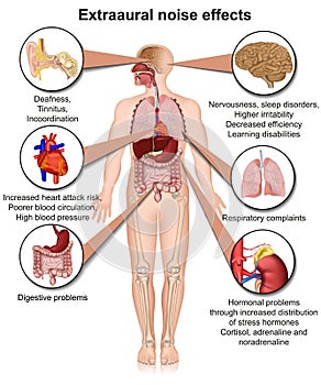 Extraaural health effects of chronic noise exposure medical  illustration