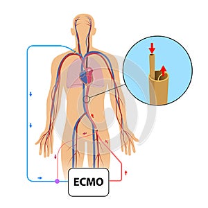 Extracorporeal membrane oxygenation,ecmo in intensive care depar
