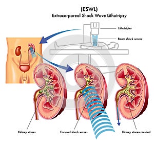 Extracorporeal shock wave lithotripsy