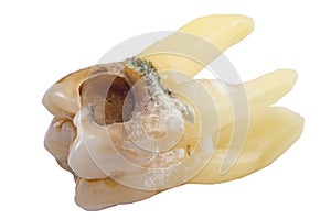 Caries tooth isolated