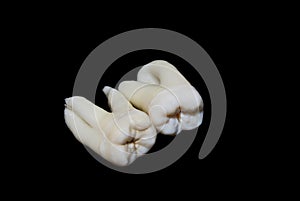 Extracted human teeth photo