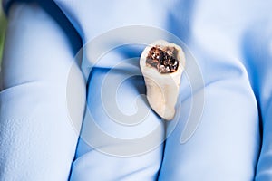 Extracted rotter molar isolated in dentistâ€™s hand with blue medical glove