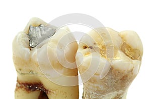 Extracted teeth with details on white background photo