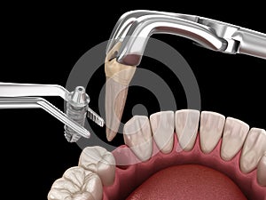 Extraction and Implantation, complex immediate surgery. Medically accurate 3D illustration of dental treatment