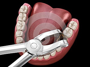 Extraction of Molar tooth damaged by caries. Medically accurate tooth 3D illustration