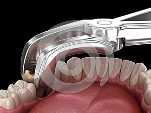 Extraction of Molar tooth damaged by caries. Medically accurate tooth 3D illustration