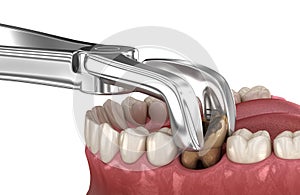 Extraction of Molar tooth damaged by caries. Medically accurate tooth 3D illustration