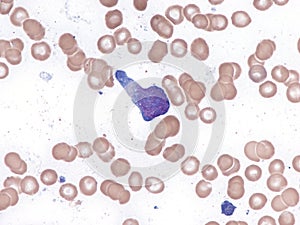 Extranodal NK T-cell lymphoma. Bone marrow cytology.