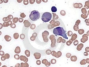 Extranodal NK T-cell lymphoma. Bone marrow cytology.