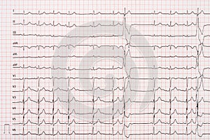 Extrasystole On 12 Lead Electrocardiogram Paper