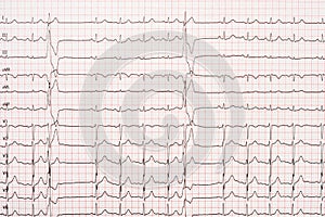 Extrasystole On 12 Lead Electrocardiogram Paper