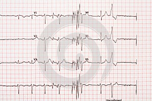 Extrasystole On 12 Lead Electrocardiogram Paper