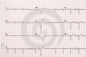 Extrasystole On 12 Lead Electrocardiogram Paper