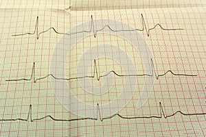 Extrasystole On 12 Lead Electrocardiogram Record Paper .