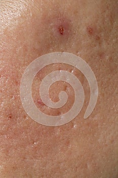 Texture of problematic human skin with large-looking open pores and acne scars