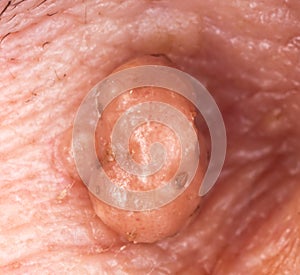 Extreme close-up of a wart.