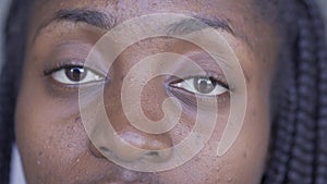 Extreme close-up of young African American woman with problem skin looking at camera. Skincare concept.