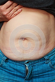 Extremely obese womans belly.