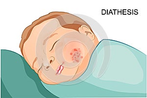 Exudative diathesis in toddler