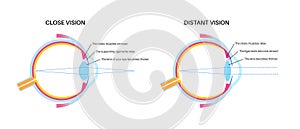 Eye accommodation poster