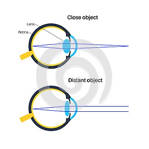 Eye accommodation poster