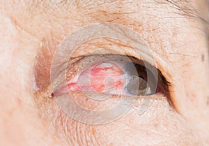 Eye pterygium in old women photo