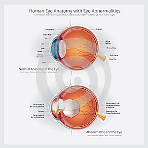 Eye Anatomy with Eye Abnormalities