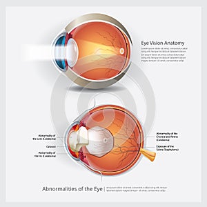 Eye Anatomy with Eye Abnormalities