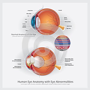 Eye Anatomy with Eye Abnormalities