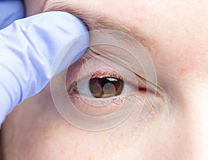 Eye with a bacterial infection