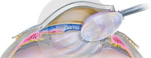 Eye - Cataract Surgery Step 1 photo
