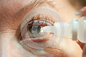 Eye with conjunctivitis is instilled with therapeutic drops photo