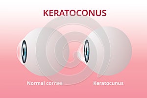Eye cornea and keratoconus, eye disorder, medical vector photo