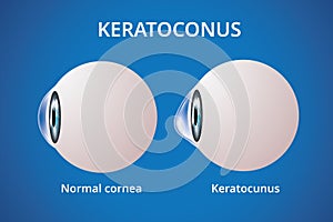 Eye cornea and keratoconus, eye disorder, medical vector