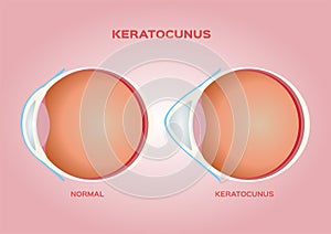 Eye cornea and keratoconus vector / anatomy