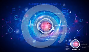 Eye with Diabetic retinopathy