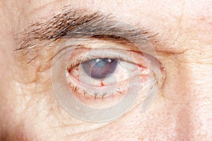 Eye disease