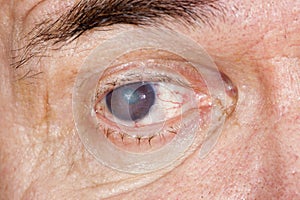 Eye disease