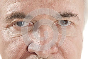 Eye disease photo