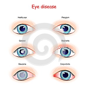 Eye disease. comparison and difference photo