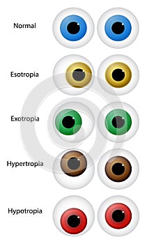 Eye Disorders photo