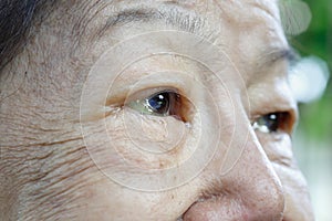 Eye edema in elderly woman