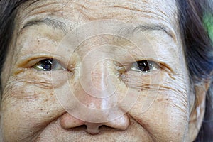 Eye edema in elderly woman photo