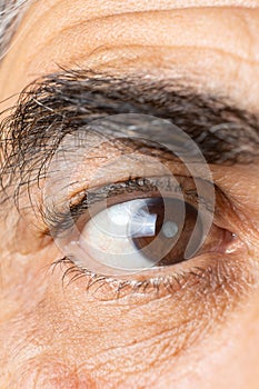 Eye of an elderly man with cataracts, clouding of the lens, macro.